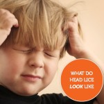 What Do Head Lice Look Like